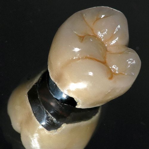 Prótesis fijas con metal