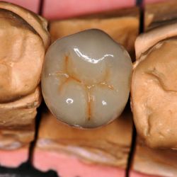 Prótesis fijas con metal