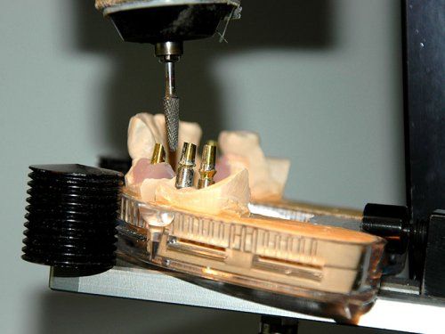 Prótesis sobre implantes de metal cerámica